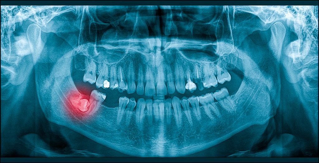 Wisdom Tooth Extraction
