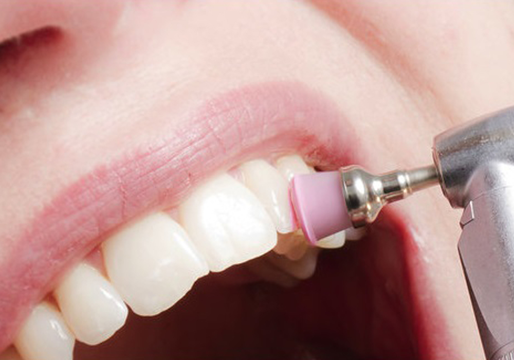 Teeth Cleaning