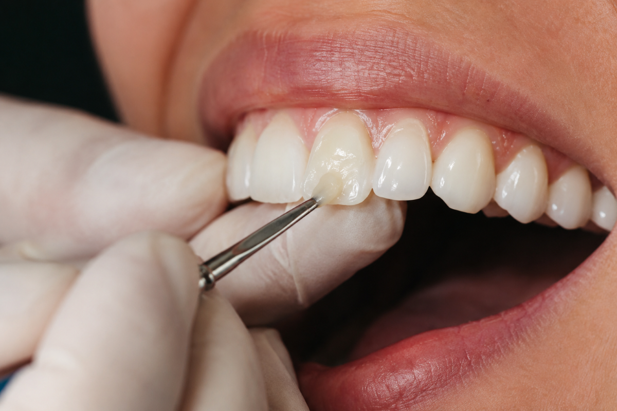 Dental Bonding in Milton | White Dove Dental Dental bonding in Milton, dentist applying tooth-colored composite resin to a front tooth at White Dove Dental