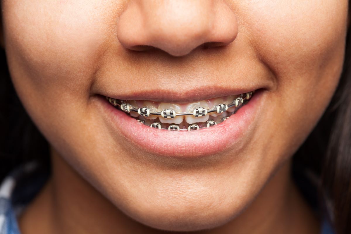 Traditional Braces