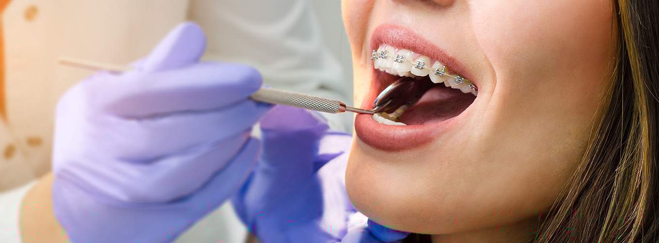 Braces